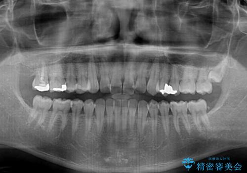 【モニター】 インビザライン・ライトによる軽微叢生の矯正治療の治療前
