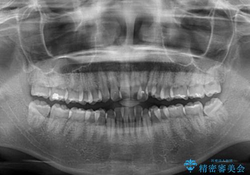 気になる八重歯を治したい 目立たないワイヤーでの抜歯矯正の治療前
