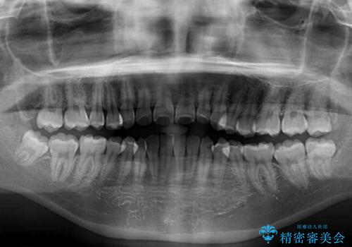 上顎骨拡大を用いたインビザラインによる非抜歯矯正の治療前