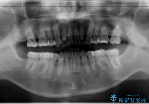 再矯正、後戻りを治したい、マウスピース矯正の治療前