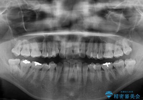 前歯のデコボコをインビザラインでスッキリとの治療前