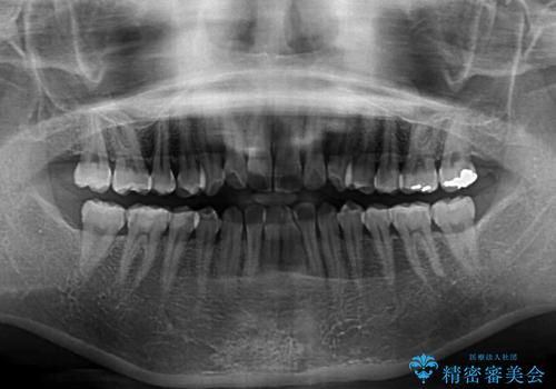 長年気にしていた前歯 インビザラインで目立たず改善の治療前