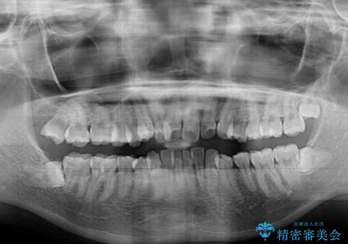口元の突出感を改善 2年弱での抜歯矯正の治療前