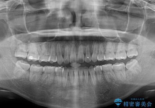 気になる八重歯を治したい 目立たないワイヤーでの抜歯矯正の治療後