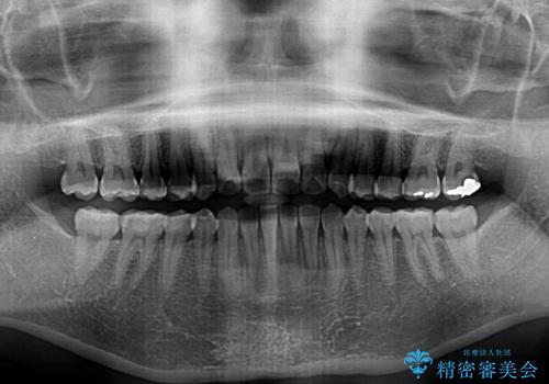 長年気にしていた前歯 インビザラインで目立たず改善の治療後