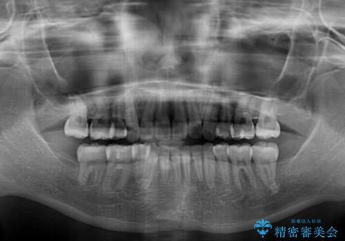 口元の突出感を改善 2年弱での抜歯矯正の治療後