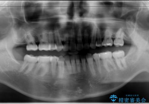 再矯正、後戻りを治したい、マウスピース矯正の治療後