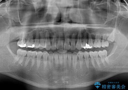 【モニター】 インビザライン・ライトによる軽微叢生の矯正治療の治療後
