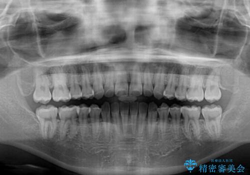 上顎骨拡大を用いたインビザラインによる非抜歯矯正の治療後