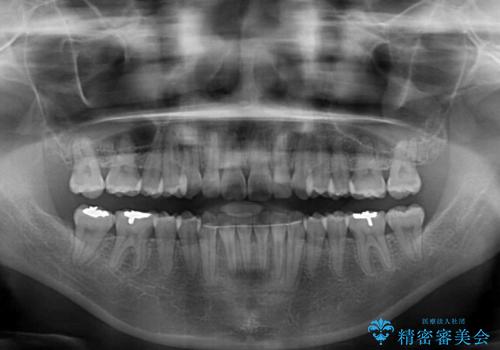 前歯のデコボコをインビザラインでスッキリとの治療後
