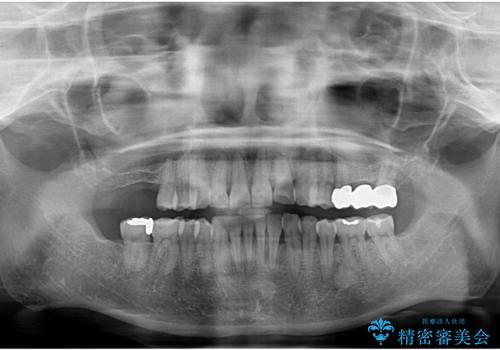 前歯が反対になっている マウスピース矯正+奥歯ブリッジの治療後