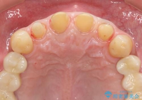 「 放置した虫歯 」 前歯セラミック治療 の治療中