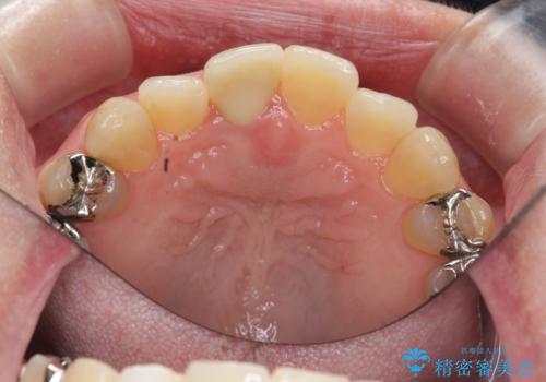 セラミッククラウン 歯ぐきの黒ずみの改善の治療後