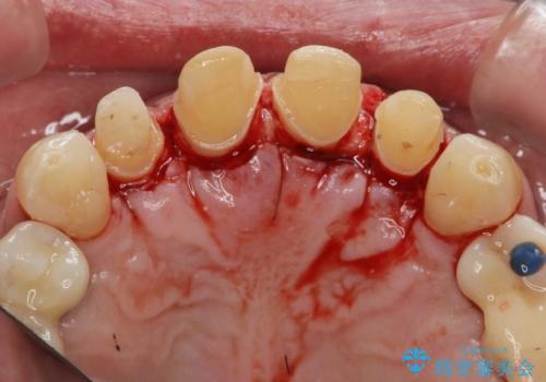 「 放置した虫歯 」 前歯セラミック治療 の治療中