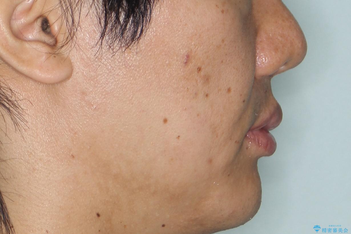 再矯正、後戻りを治したい、マウスピース矯正の治療前(顔貌)