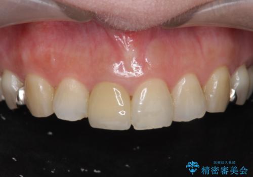 セラミッククラウン　歯ぐきの黒ずみの改善の症例 治療後