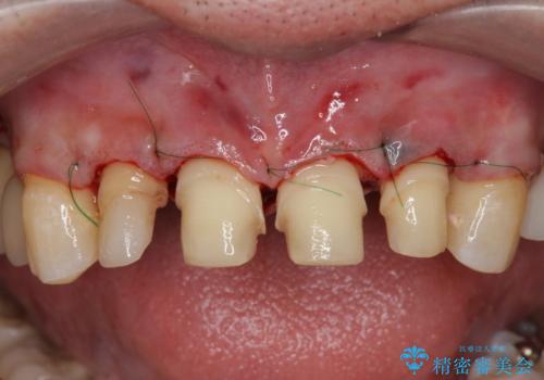 「 放置した虫歯 」 前歯セラミック治療 の治療中