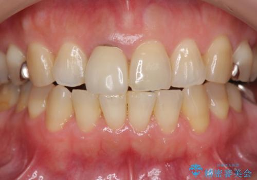 セラミッククラウン 歯ぐきの黒ずみの改善の治療前