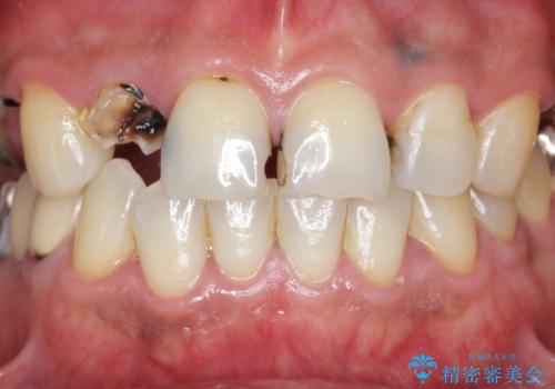「 放置した虫歯 」 前歯セラミック治療 の治療前