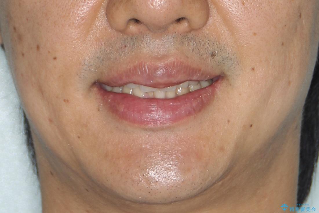 再矯正、後戻りを治したい、マウスピース矯正の治療前(顔貌)