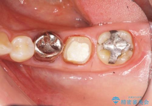 大人になってからの乳歯脱落 セラミックブリッジによる補綴の治療中