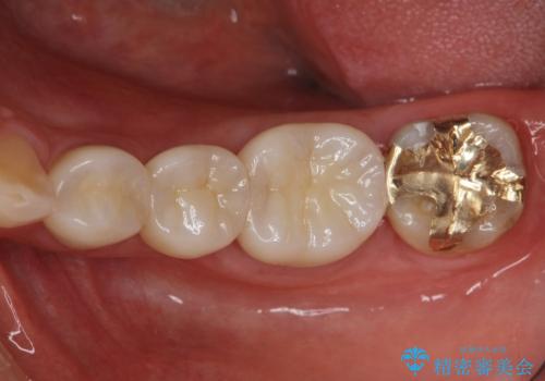 大人になってからの乳歯脱落 セラミックブリッジによる補綴の治療後