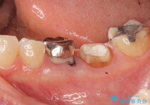 大人になってからの乳歯脱落 セラミックブリッジによる補綴の治療中