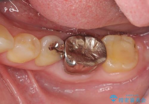 噛むと痛い銀歯 根管治療を伴うやりかえの治療前