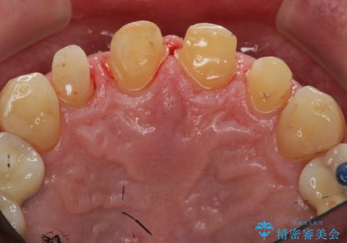「 放置した虫歯 」 前歯セラミック治療 の治療中
