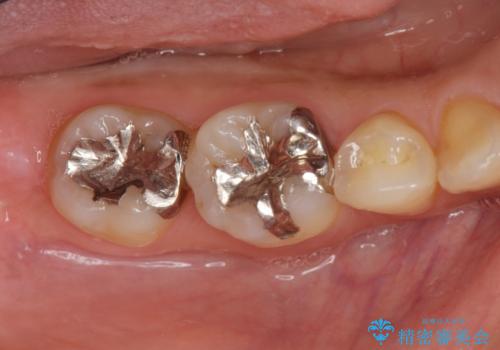 銀歯を白く　セラミックインレー治療の症例 治療前