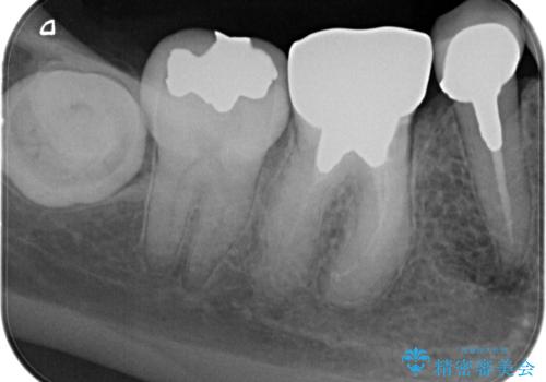 【外部吸収】根管治療、外科治療からのオールセラミッククラウンの治療前