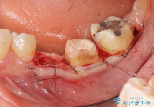 大人になってからの乳歯脱落 セラミックブリッジによる補綴の治療中