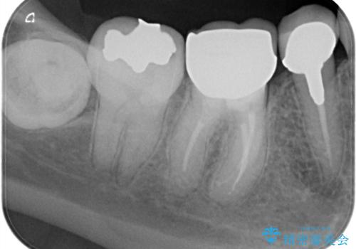 【外部吸収】根管治療、外科治療からのオールセラミッククラウンの治療後