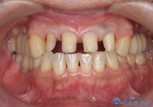 「 放置した虫歯 」 前歯セラミック治療 の治療中