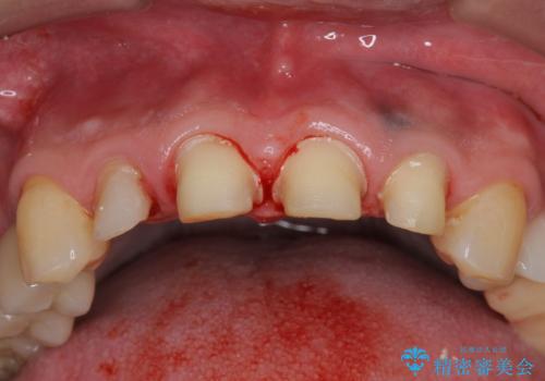 「 放置した虫歯 」 前歯セラミック治療 の治療中