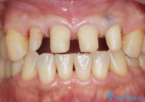 「 放置した虫歯 」 前歯セラミック治療 の治療中