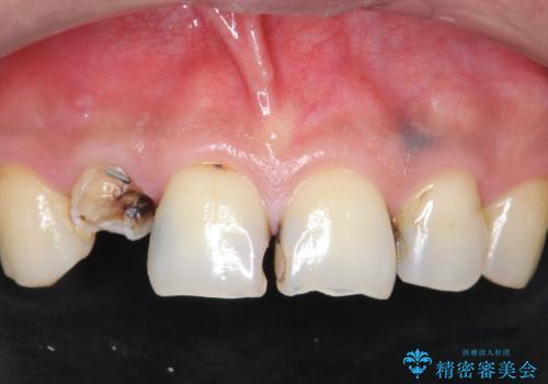 「 放置した虫歯 」 前歯セラミック治療　の症例 治療前
