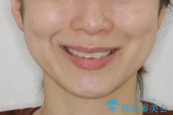 上下の真ん中を合わせて横顔シルエットも改善の治療前(顔貌)