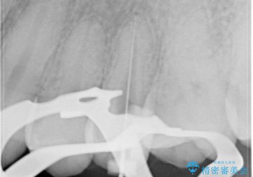 根管治療〜オールセラミッククラウンの治療中