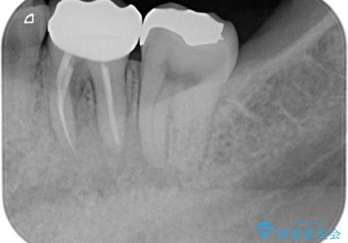 根管治療から被せ物の治療の治療後