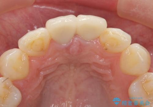 前歯が疼く セラミッククラウンのやり替えの治療後