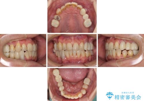 歯並びや奥歯の痛み 色々と治したい 総合歯科診療の治療後
