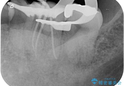 根管治療から被せ物の治療の治療中