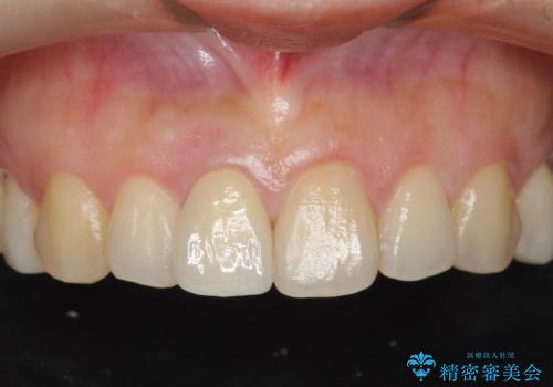 オーダーメイドで造る、自然な前歯セラミッククラウンの症例 治療後