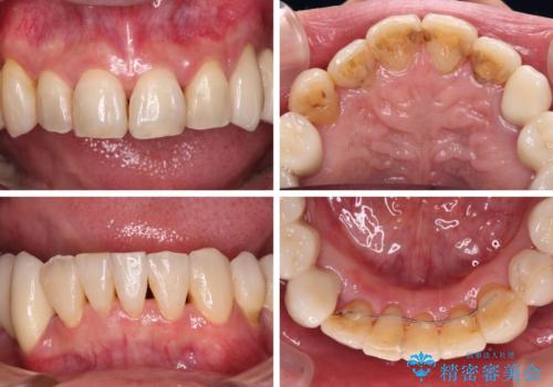 歯並びや奥歯の痛み 色々と治したい 総合歯科診療の治療後