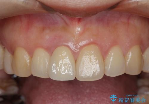 オーダーメイドで造る、自然な前歯セラミッククラウンの治療後