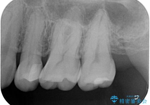 適合の良いセラミックインレー の治療後