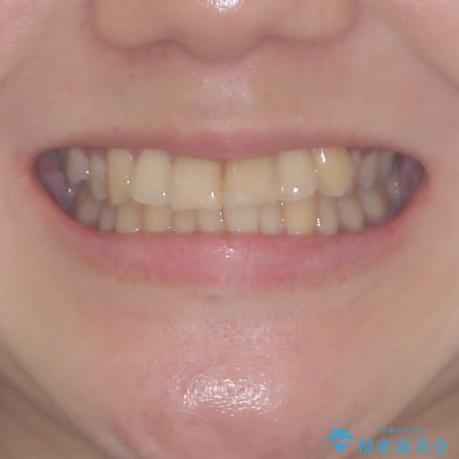 上下前歯のデコボコをきれいに　インビザラインによる矯正治療の治療前（顔貌）
