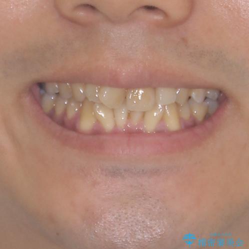 上顎の狭い歯列をインビザラインで拡大の治療前（顔貌）