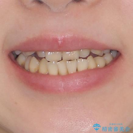 どこで咬んで良いのか分からない インビザラインでの咬み合わせの改善の治療前(顔貌)